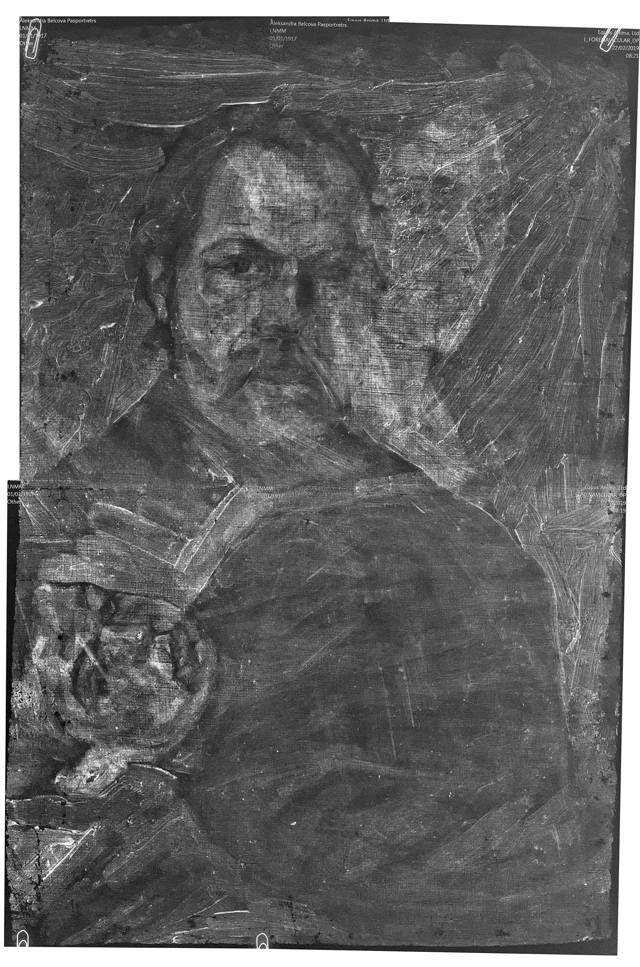 Rentgenogramma no virspuses restaurācijas gaitā